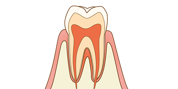 虫歯治療