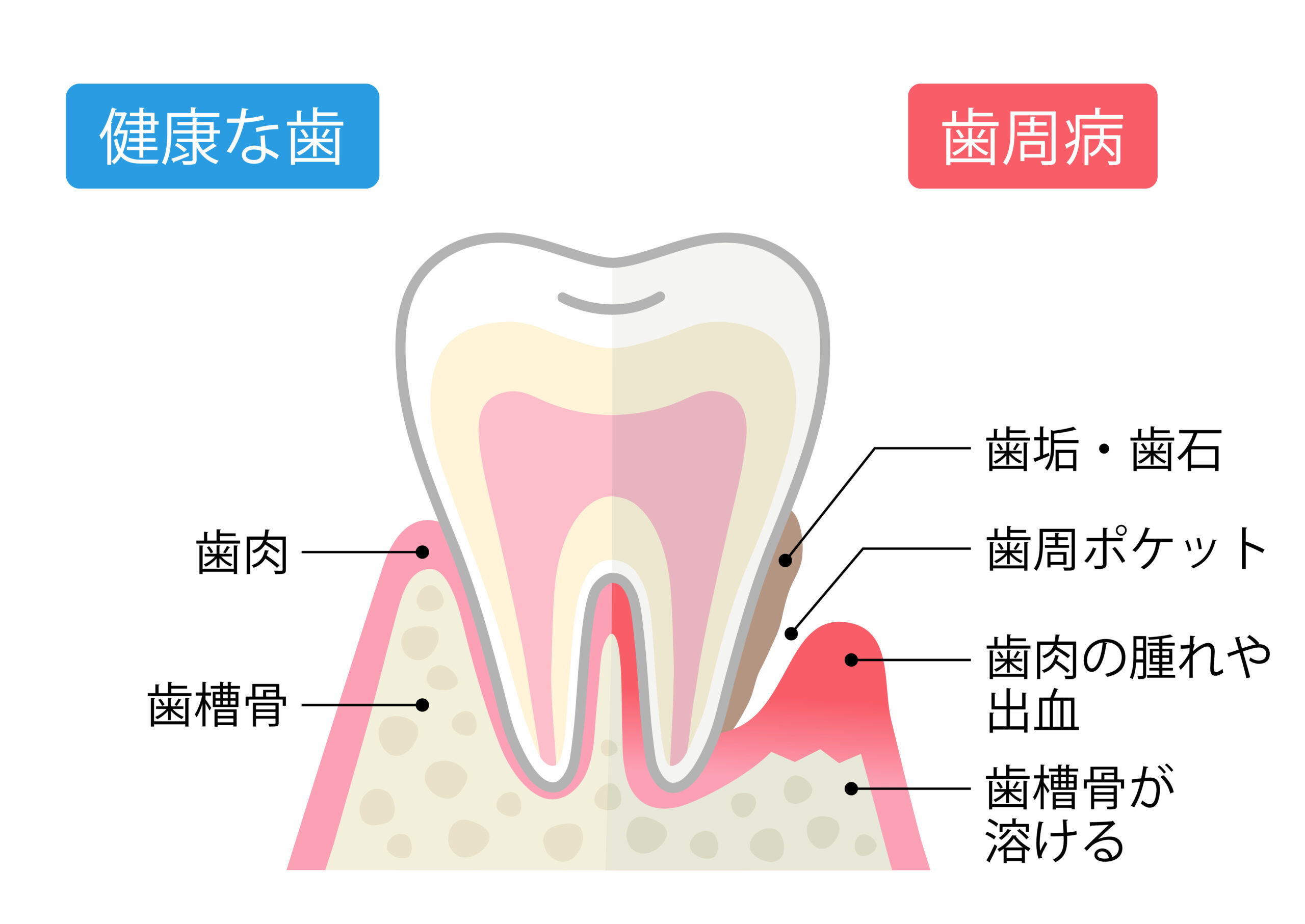 歯周病と健康な歯　比較　断面図