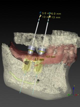 インプラント手術のシュミレーション