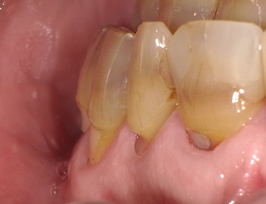 露出した歯の根