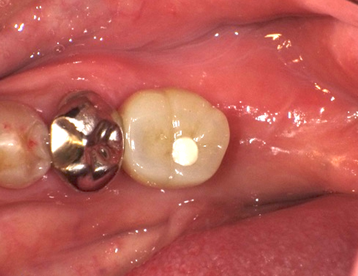 クラウンをつけて歯茎に埋め込まれたインプラントの状態
