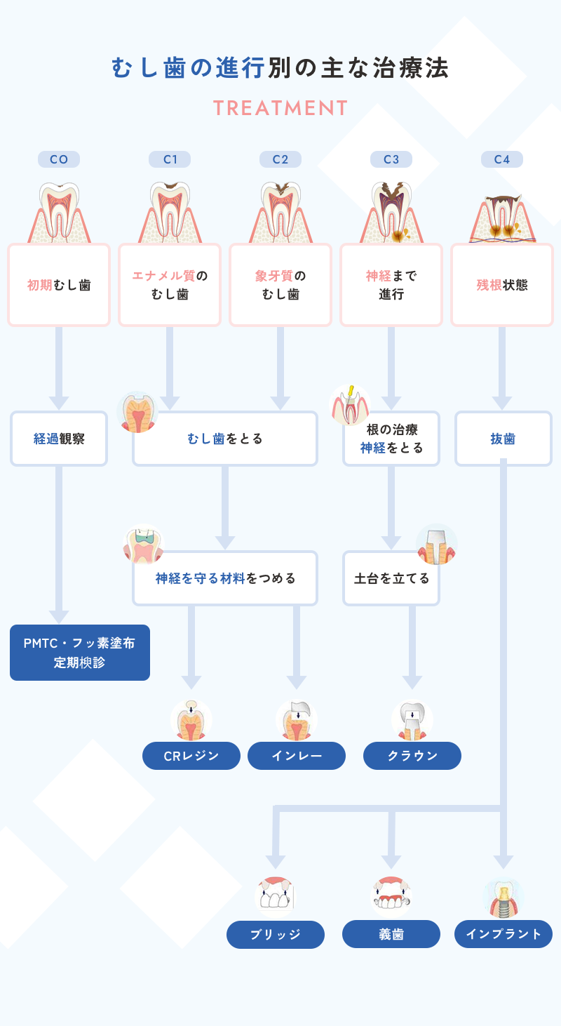 虫歯の進行度と治療